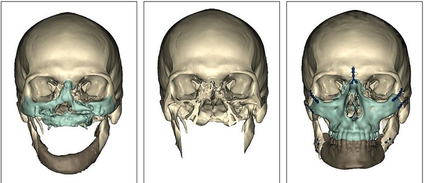 Na skeneru se vide prvobitne povrede na Norisovom licu (levo), zatim nakon uklanjanja i posle operacije (desno)