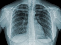 WHO: Po raz pierwszy od 10 lat roczny wzrost liczby zgonów na gruźlicę