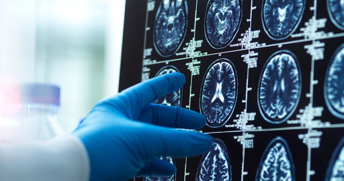 Co powoduje rozwój choroby Alzheimera? "Kolejny istotny element układanki"