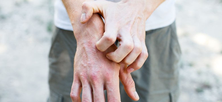 Eksperci: Chorzy na atopowe zapalenie skóry potrzebują terapii biologicznej