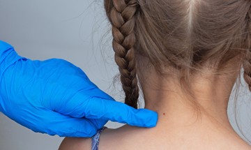 Egyik napról a másikra kijöhetnek  új anyajegyek az erős napsütéstől? Az orvos válaszol
