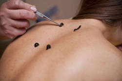 W czasie pandemii trzykrotnie wzrosła sprzedaż pijawki lekarskiej