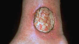 pyoderma