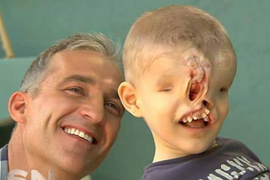 Rođen je BEZ OČIJU I NOSA, roditelji su ga krili, a onda je hirurg izveo ČUDO: "Dečak bez lica" 10 godina kasnije izgleda NEPREPOZNATLJIVO