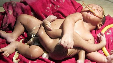 Indie: urodził się z czterema rękami i czterema nogami. Mówią o nim "boskie dziecko"