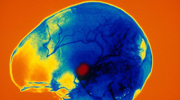 Jak choruje głowa? Groźne choroby, które mogą doprowadzić do śmierci