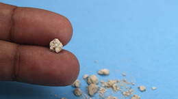 Kamienie nerkowe – czym się charakteryzują? W jaki sposób można usunąć je z organizmu? [WYJAŚNIAMY]