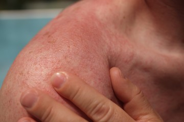 Napallergia: így néznek ki az allergiás tünetek a bőrön