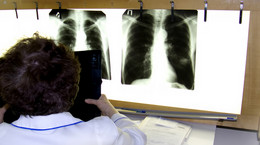Diagnostyka raka płuca