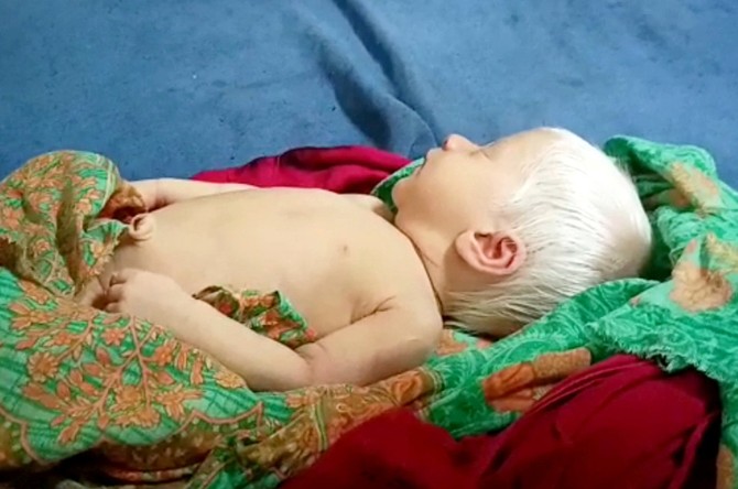Albino beba