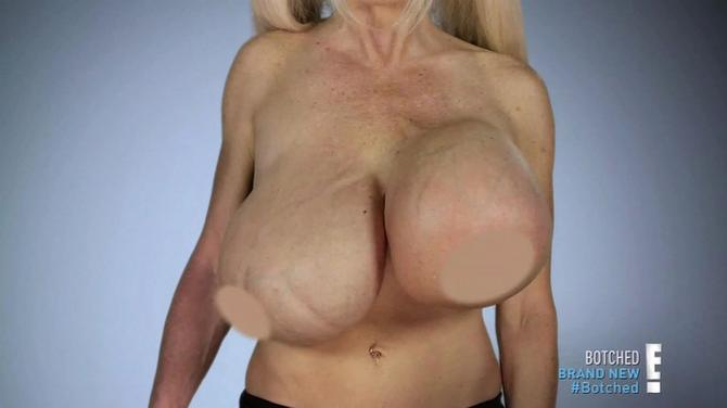 Porno zvezda Elizabet Star ima velike probleme sa silikonima u grudima