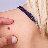Így védje magát a melanomától