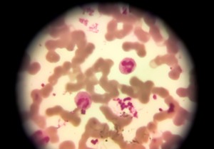 Esencijalna trombocitemija