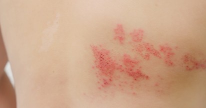 Övsömör (Herpes varicella zoster)