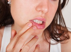 Dokuczliwe afty i opryszczki. Skąd się biorą i czym je leczyć?