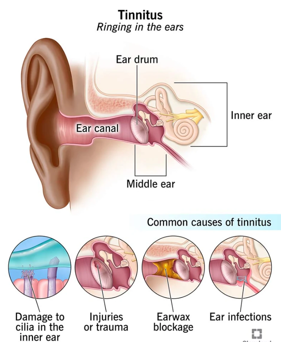 Tinitus je simptom stanja kao što su povrede uha, blokada ušnog voska ili gubitak sluha povezan sa starenjem