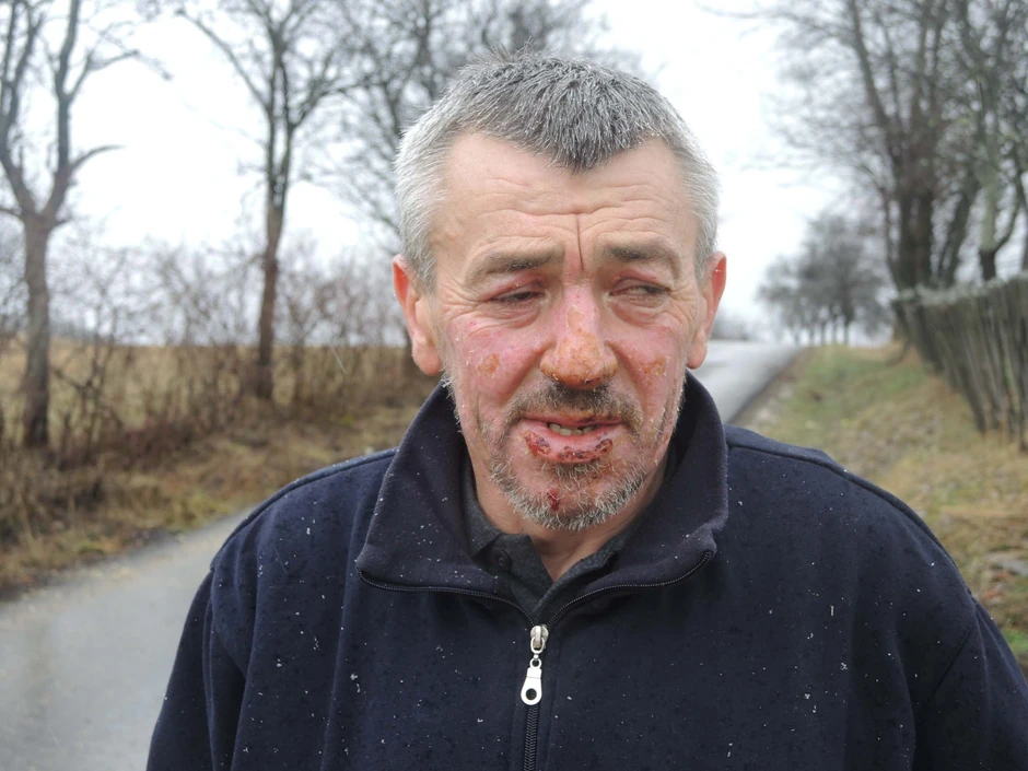 Zbog opekotina na licu i rukama 10 dana je ležao u užičkoj bolnici