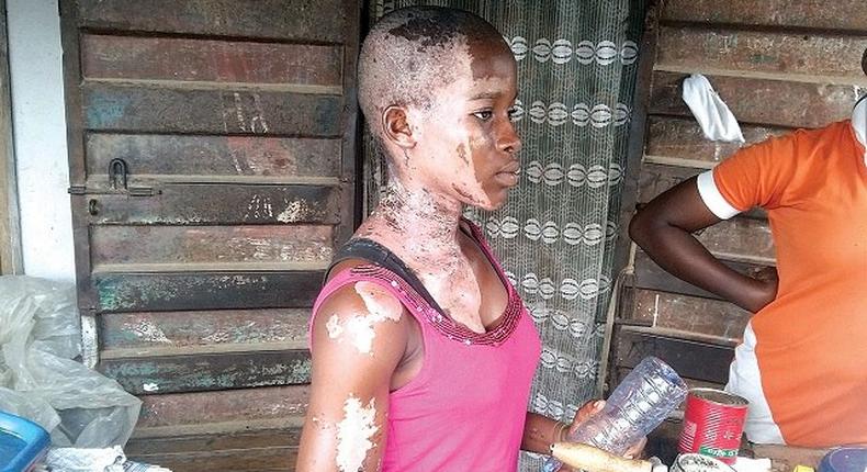 Victoria Emmanuel was bathed with acid while celebrating her birthday