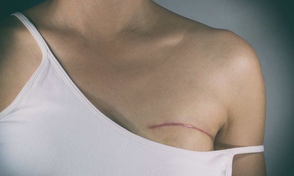 Zmagała się z gigantomastią. Zmniejszyła piersi z rozmiaru N do C