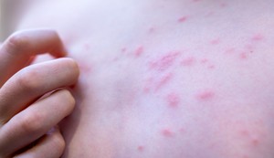 Stopala su posebno izložena ujedima ovih buba jerdolaze u direktan kontakt sa peskom, kamenjem, školjkama, insektima i morskom vodom
