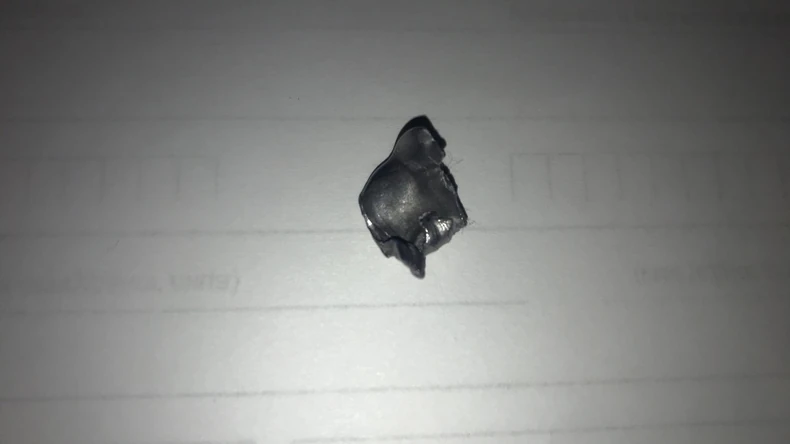 Metak koji je izvađen iz ruke mladića