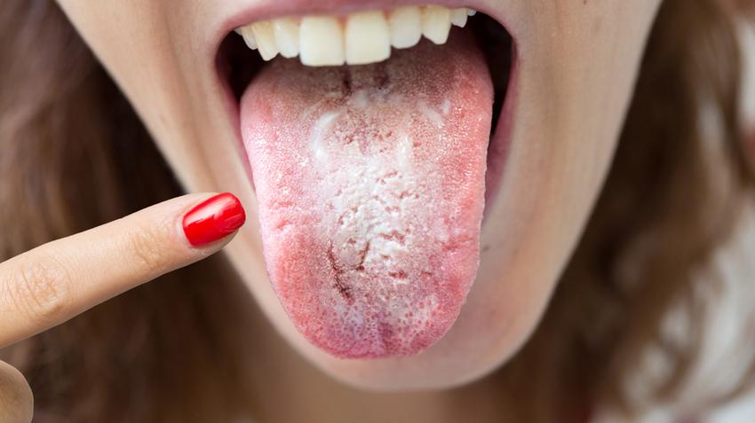 Hogyan szüntessük meg a cukorbetegség okozta szájszárazságot? - instantplace.hu