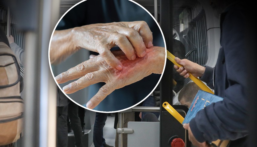 Šuga se veoma brzo širi direktnim kontaktom koža na kožu