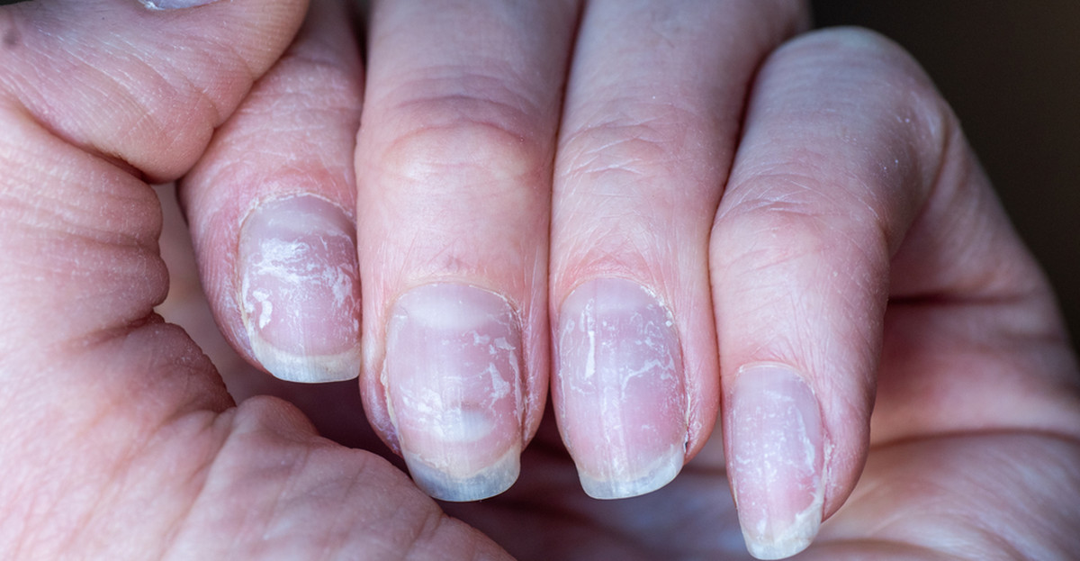 Jak uratować paznokcie po hybrydzie?