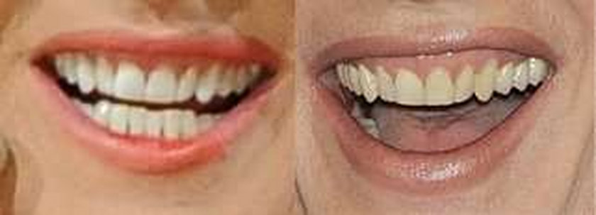 Co się stało z zębami Kory! ZDJĘCIA