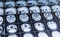 Leki steroidowe mogą powodować zmiany w strukturze mózgu [BADANIA]