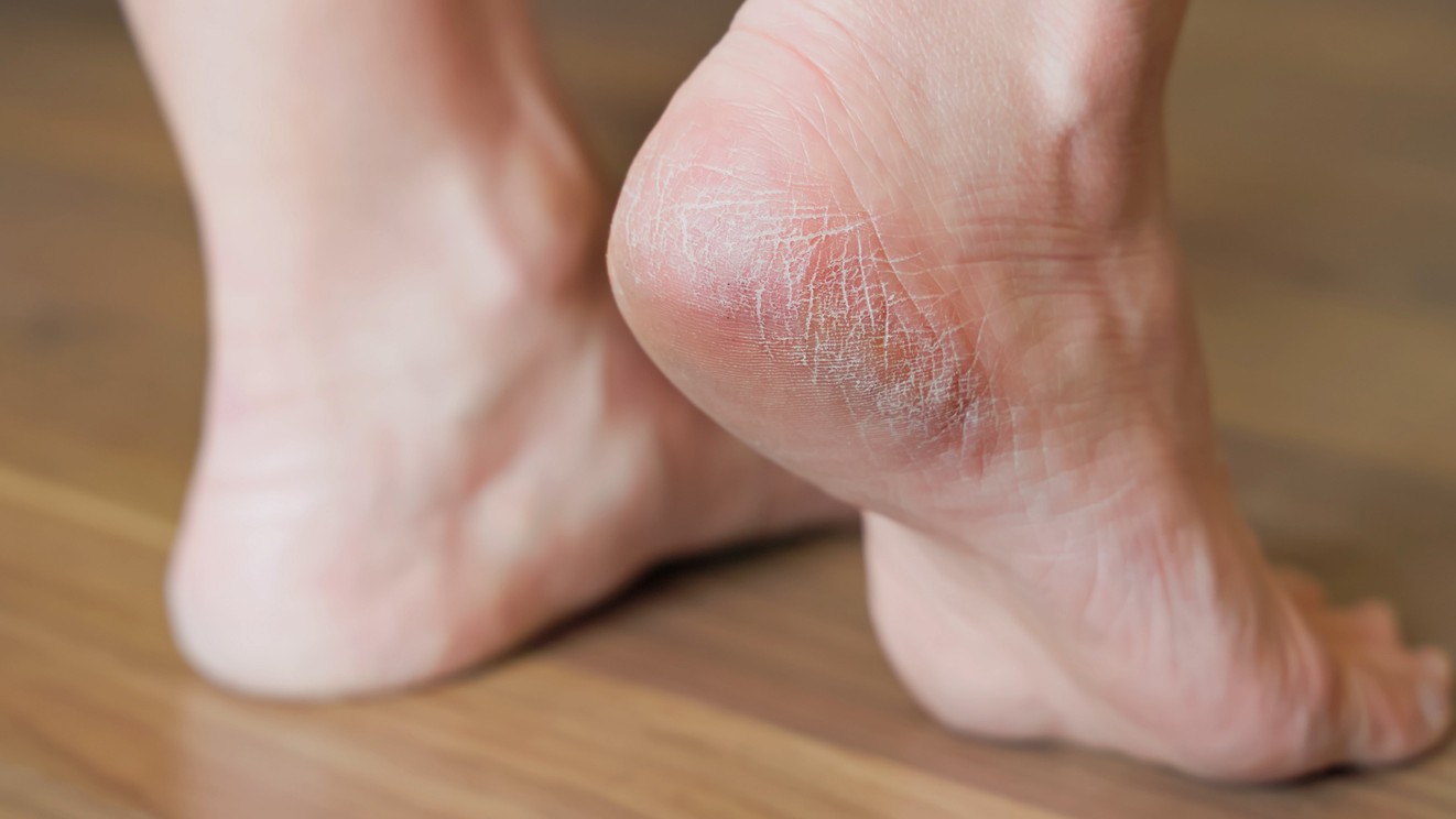 Popraskané päty nemusia byť spôsobené zlou obuvou. (ilustračné foto)