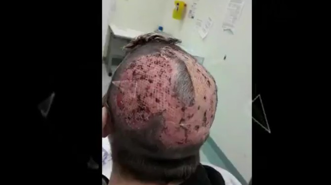Kada su joj hirurzi podigli to malo kose koja joj je ostala, sa njom je otišla i koža glave