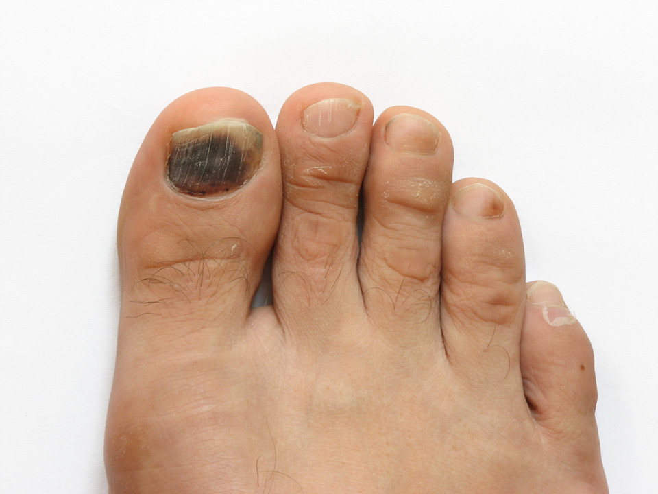 Czarne barwa paznokci, punktowe zmiany na paznokciach