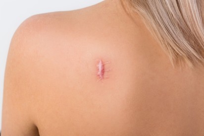 Hegek a bőrön: ezekkel az eljárásokkal lehet eltüntetni, halványítani őket