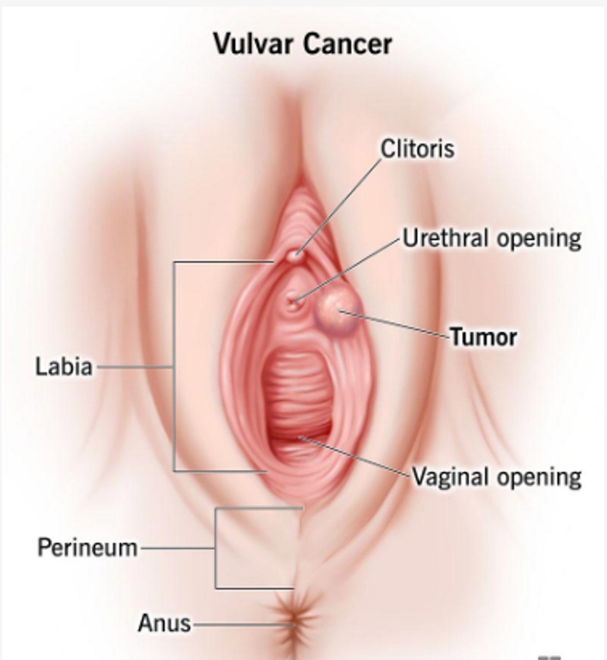 Rak vulve je rak koji počinje kao rast ćelija na vulvi. Vulva je područje kože koje okružuje uretru i vaginu