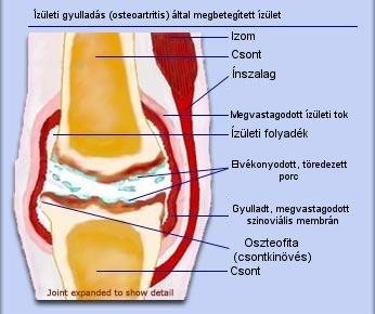 osteoartritis-d000002F846b97e6ee346