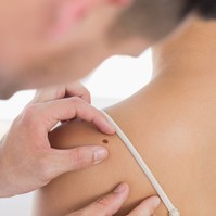 Szabad-e tavasszal levetetni az anyajegyet? Az orvos elmondja