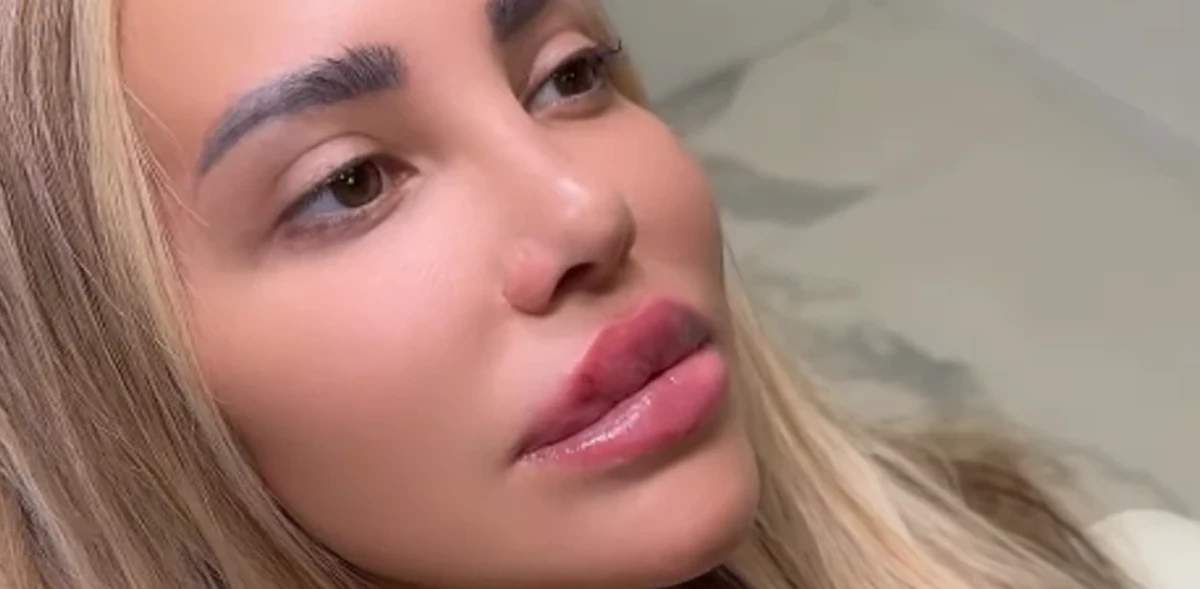 Napravila je "usnice" i podigla nos, a evo kako je Aneli Ahmić izgledala pre svih korekcija! (Foto)