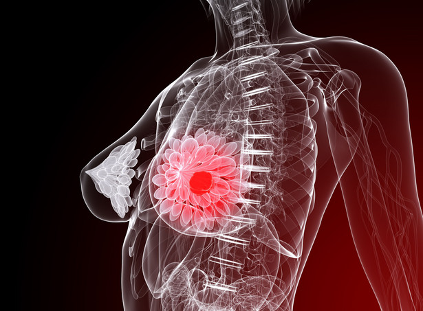 Czy profilaktyczna mastektomia jest możliwa w Polsce?