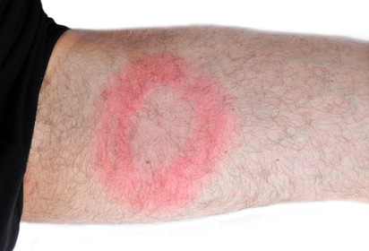 Ígéretes kutatás: hamarosan megelőzhető és kezelhető lesz a Lyme-kór?