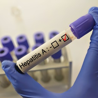 Hepatitisz A: tünetei, vizsgálata és kezelési lehetőségei