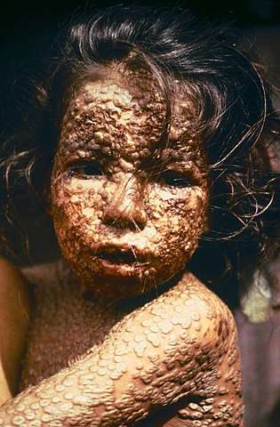 Dziecko chore na ospę prawdziwą (Bangladesz, 1973)