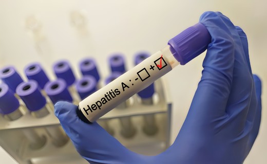 Hepatitisz A
