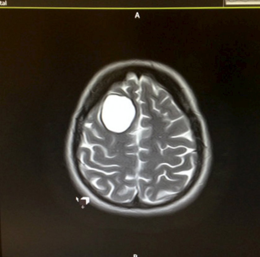 Podczas porodu wykryli nowotwór mózgu