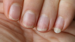Jak leczyć pękające paznokcie?