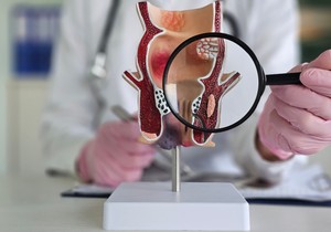 U anusu postoji mnogo žlezda, a kada se jedna od njih začepi, može da dovede do infekcije i stvaranja apscesa