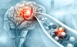 Udar mózgu jest drugą po chorobach serca najczęstszą przyczynę śmierci Polaków. OBJAWY