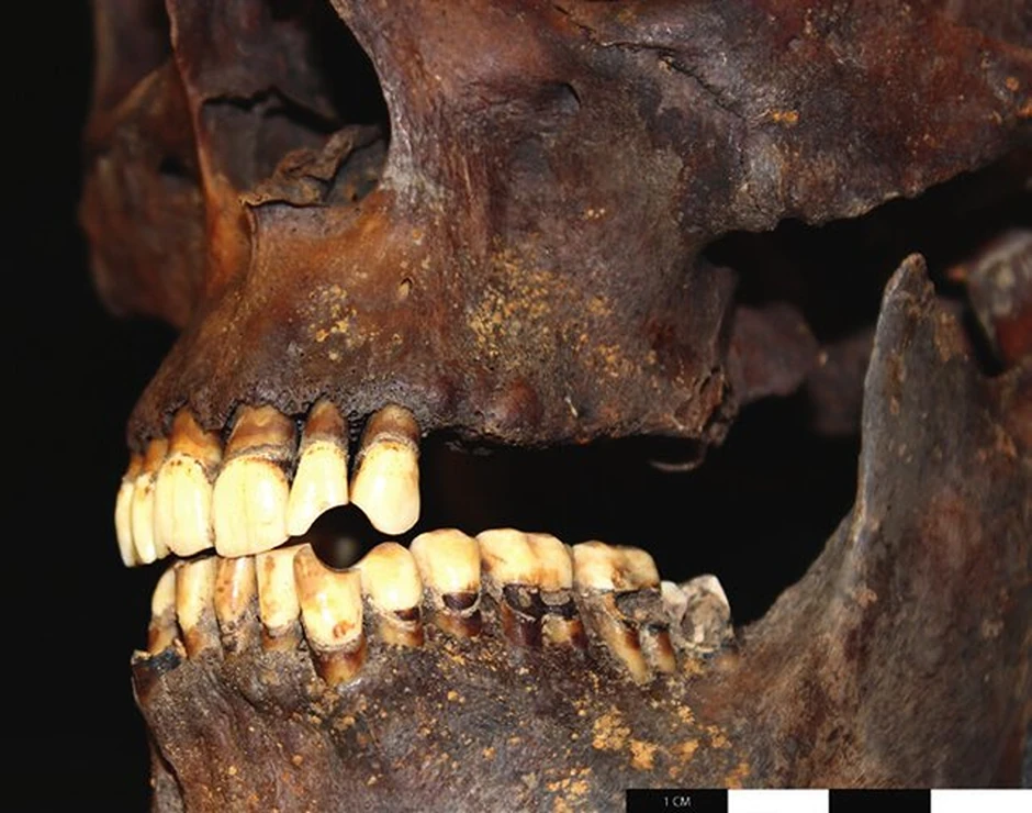 Tragovi upotrebe lule sa duvanom na zubima