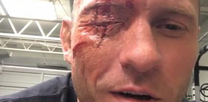 Straszna rana na twarzy zawodnika MMA. Skąd się wzięła?