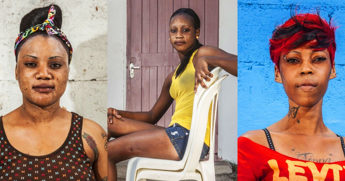 Homemade bleaching creams and their negative side effect Pulse Ghana